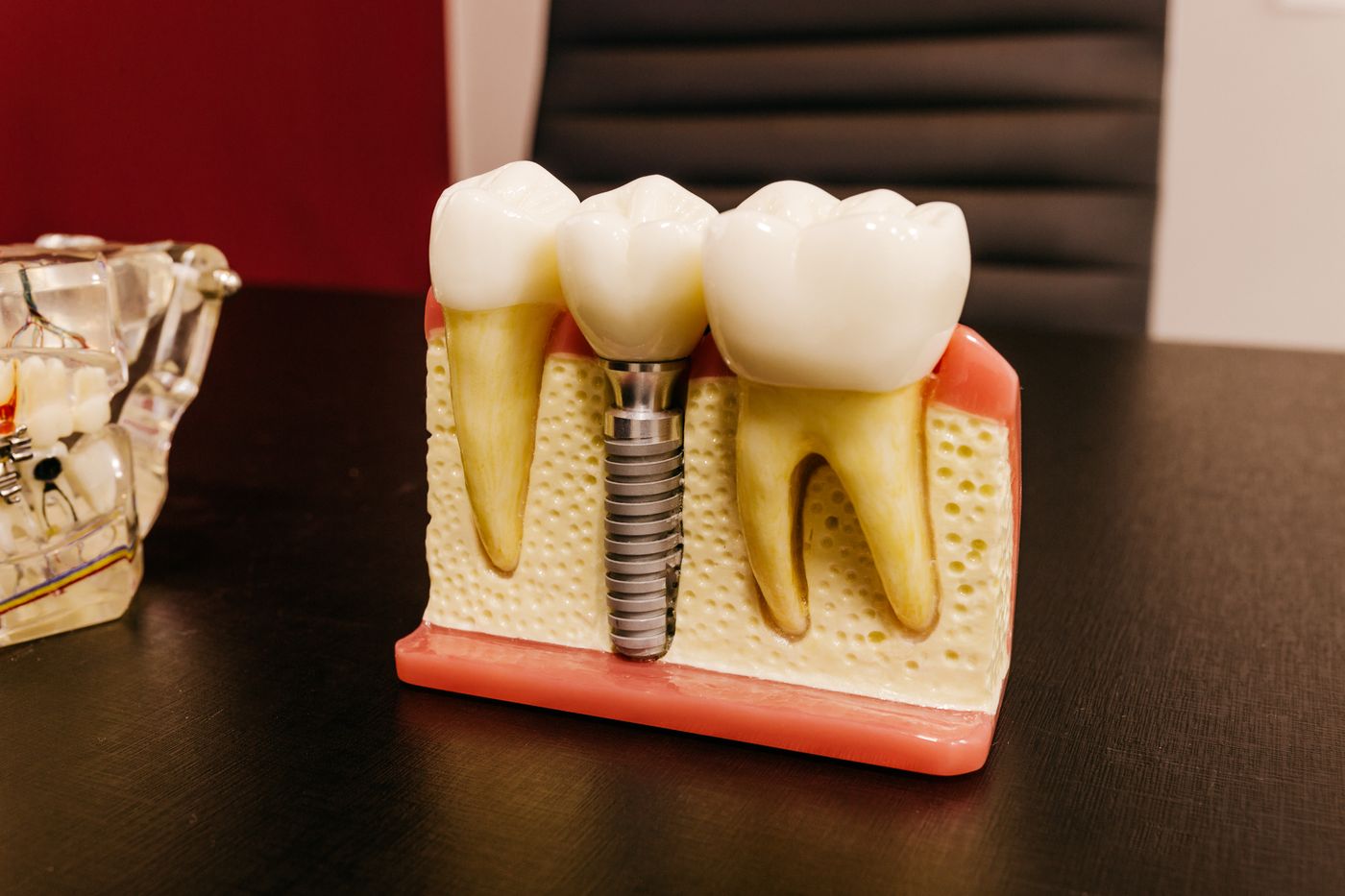Photograph of a physical dental implant demonstration model